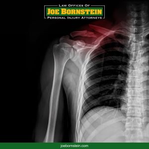 The xray of a broken shoulder following an accident in Biddeford caused by negligence