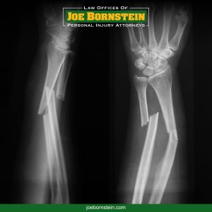 An xray showing both arms have been broken after an accident in Windham